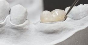 Park City Cosmetic Dentist for Inlays / Onlays