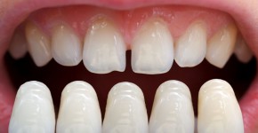 Park City Dentist Providing Veneers